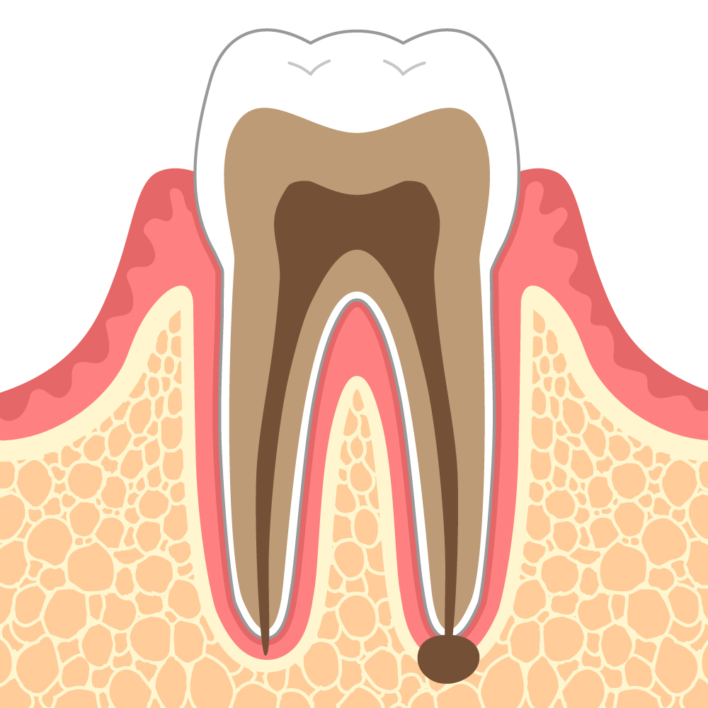 歯 の 根っこ 膿